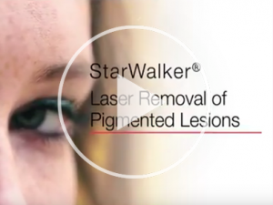 Laser pigmentation removal