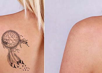 Laser Tattoo Removal